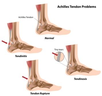 Common Achilles Tendon Problems